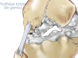 Votre prothèse de genou à la Clinique Arago