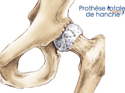 Votre prothèse de hanche à la Clinique Arago